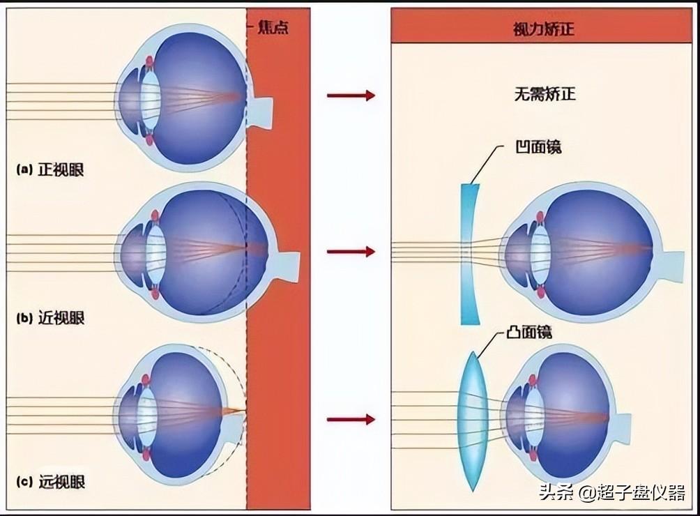 近视兵检过了是否需要激光手术,深度解析与探讨,近视兵检通过后是否需要激光手术,深度探讨与解析