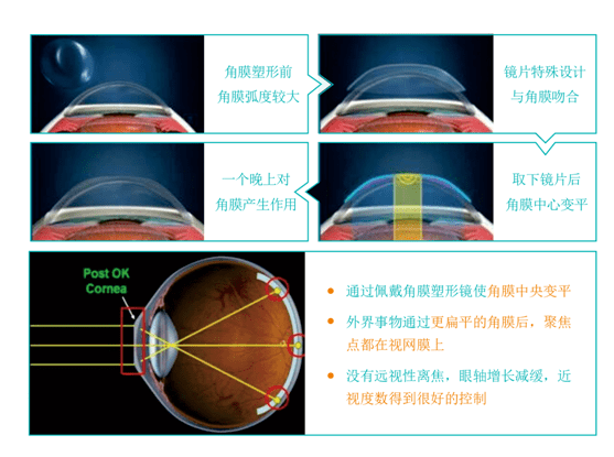 角膜塑形镜,近视控制的真实效果探究,角膜塑形镜对近视控制的实际成效探究