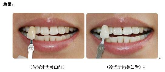 美白牙齿，打造灿烂笑容的关键，美白牙齿，打造自信灿烂笑容的秘诀