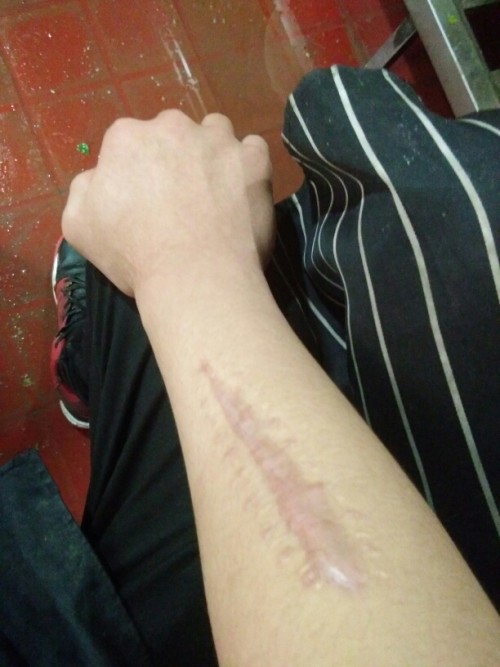 手臂上有疤痕可以当兵吗，解读征兵政策与疤痕影响，解读征兵政策，手臂疤痕对当兵的影响分析