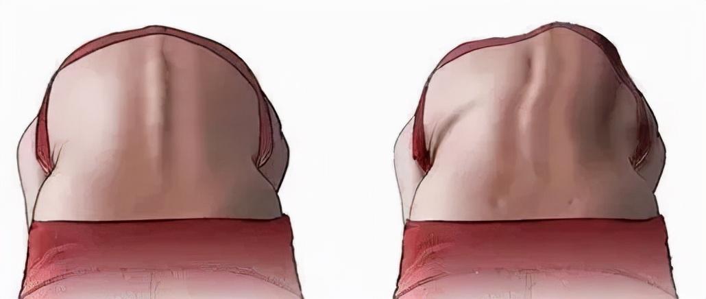 解决肩膀和背部厚实，有效的减厚方法，减厚秘籍，告别厚实肩膀与背部，塑造轻盈身姿